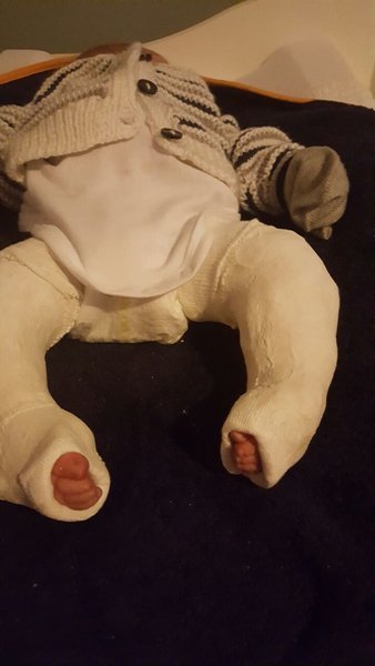 Baby_Clubfoot_corrected