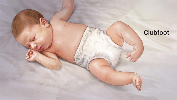 Main_Baby_Clubfoot_1
